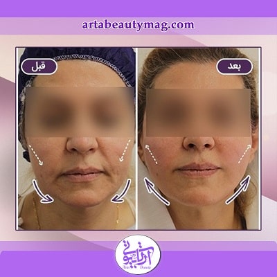 لیفت صورت با نخ در آرتا بیوتی