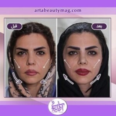 لیفت صورت با نخ در آرتا بیوتی
