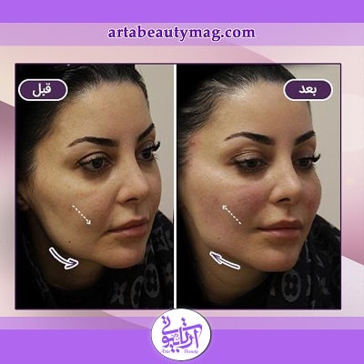 لیفت صورت با نخ در آرتا بیوتی