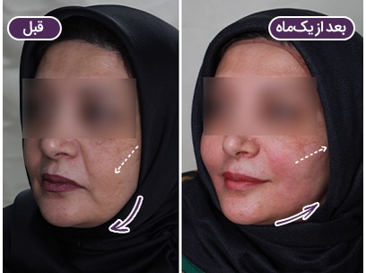نمونه کارهای لیفت با نخ دکتر مرتضی جلالی فخر