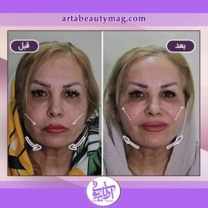 لیفت با نخ در آرتا بیوتی