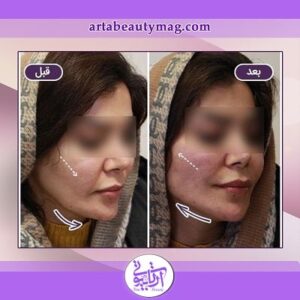 لیفت با نخ در آرتا بیوتی