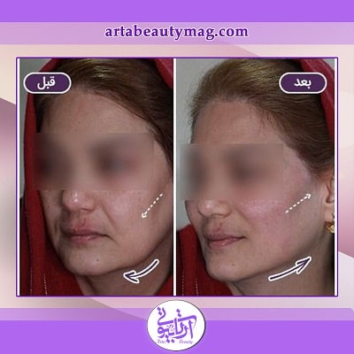 چه افرادی نباید لیفت با نخ انجام دهند؟
