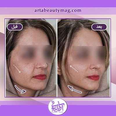 چه کسانی کاندیدای نامناسب لیفت با نخ هستند؟