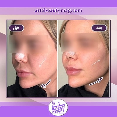 چه خطراتی برای کاندیدای نامناسب لیفت با نخ وجود دارد؟