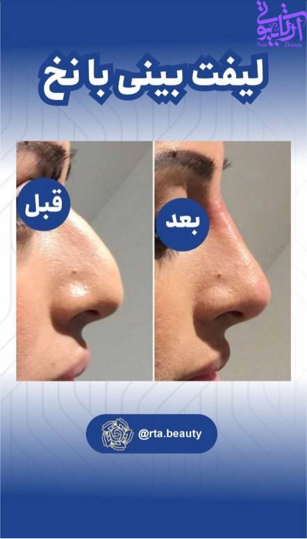 لیفت بینی با نخ در آرتا بیوتی