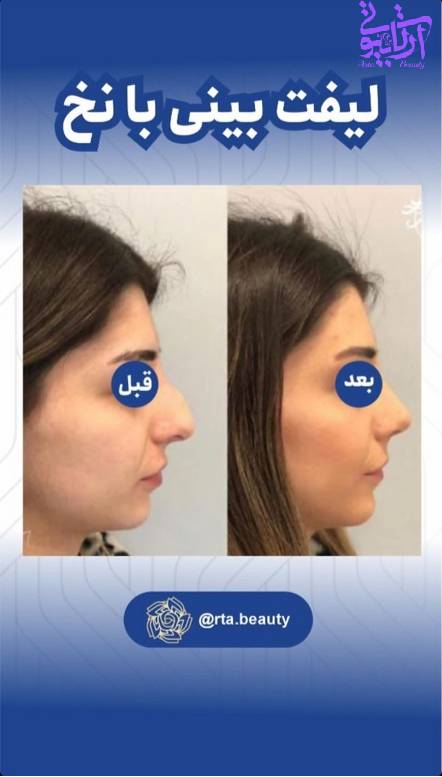لیفت بینی با نخ در آرتا بیوتی