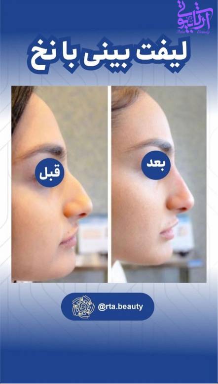 لیفت بینی با نخ در آرتا بیوتی