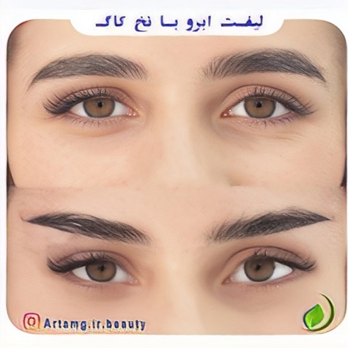 نمونه کار لیفت ابرو با نخ دکتر جلالی فخر
