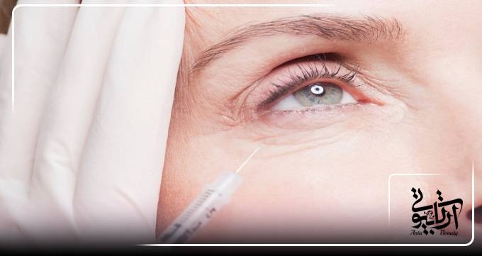 بوتاکس دور چشم در کلینیک آرتا بیوتی