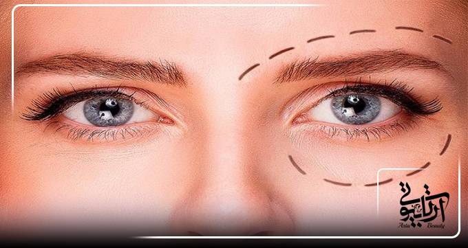 جراحی بلفاروپلاستی در آرتا بیوتی