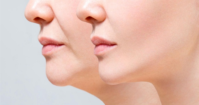 همه چیز درباره غبغب