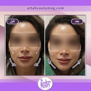جوانسازی پوست در آرتابیوتی