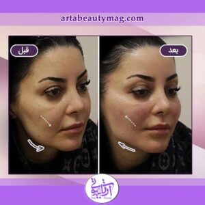 جوانسازی پوست در آرتابیوتی
