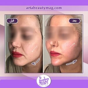 نمونه کار لیفت صورت با نخ در آرتابیوتی