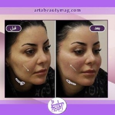 نمونه کار لیفت صورت با نخ در آرتابیوتی