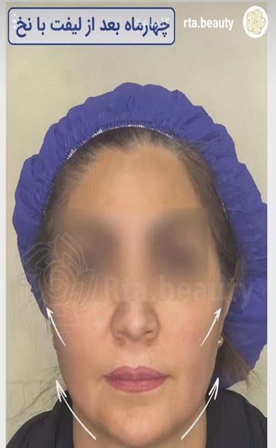 نمونه کار لیفت با نخ دکتر مرتضی جلالی فخر
