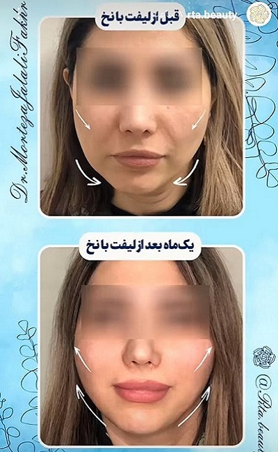 نمونه کار لیفت با نخ دکتر مرتضی جلالی فخر