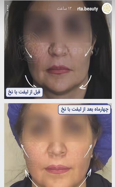 نمونه کار لیفت با نخ دکتر مرتضی جلالی فخر