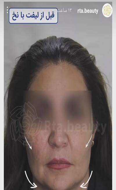 نمونه کار لیفت با نخ دکتر مرتضی جلالی فخر 