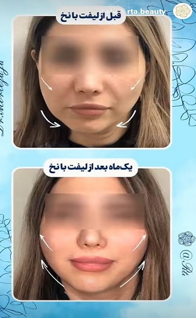 نمونه کار لیفت با نخ دکتر مرتضی جلالی فخر