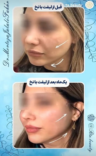 نمونه کار لیفت با نخ دکتر مرتضی جلالی فخر