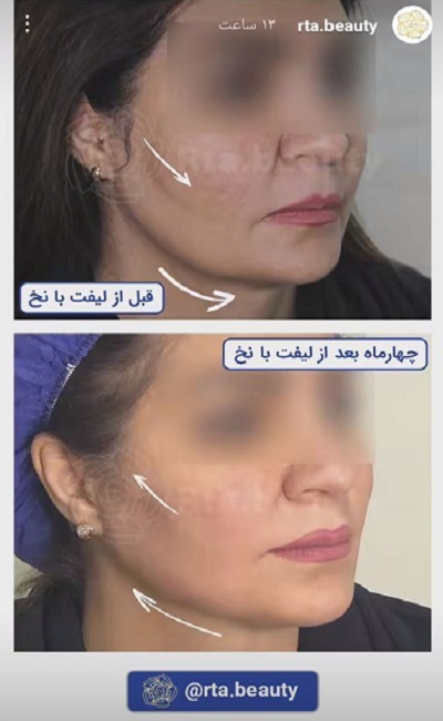 نمونه کار لیفت با نخ دکتر مرتضی جلالی فخر
