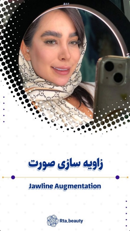 فیلر صورت در آرتابیوتی