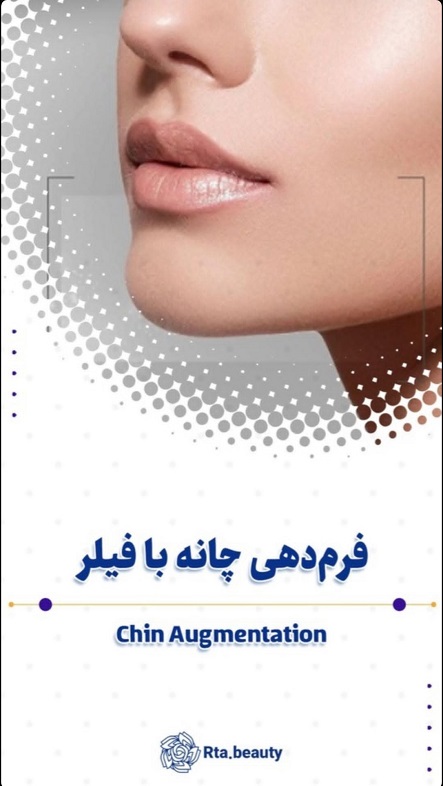 فیلر صورت در آرتابیوتی