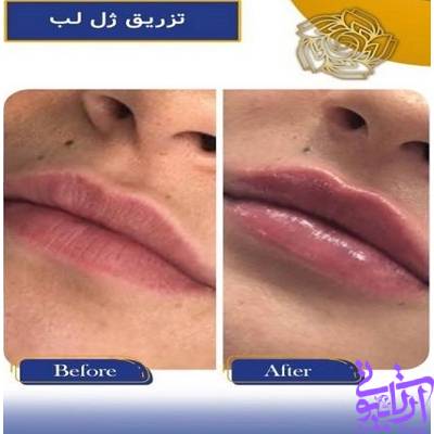 نمونه کار تزریق ژل لب در آرتابیوتی