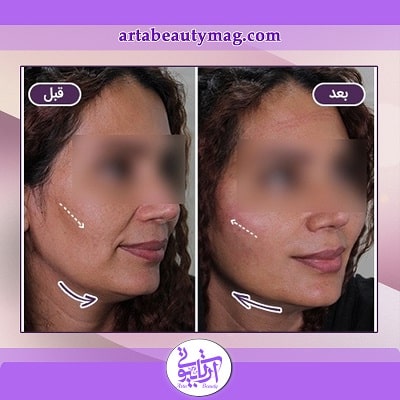 نمونه کار مزوتراپی پوست در آرتابیوتی