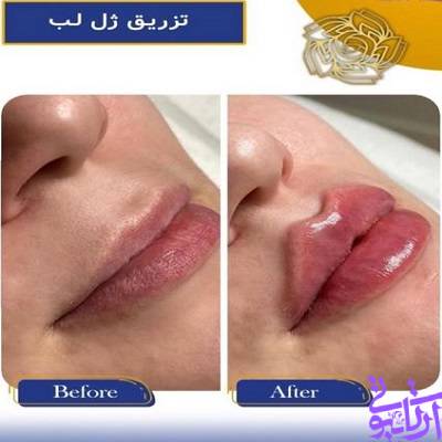 نمونه کار تزریق ژل لب در آرتابیوتی