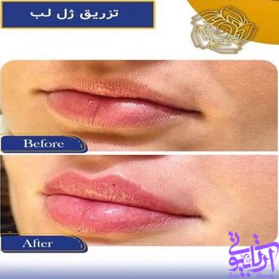 نمونه کار تزریق ژل لب در آرتابیوتی