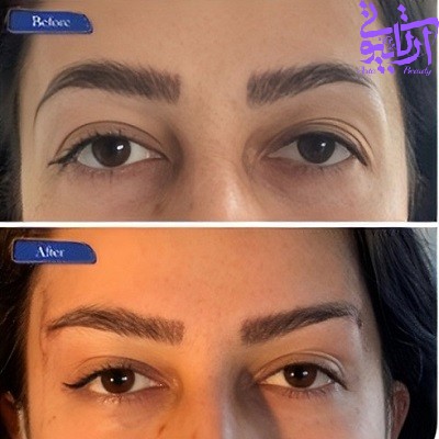 نمونه کار لیفت ابرو با نخ دکتر جلالی فخر