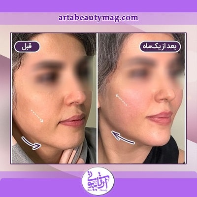نمونه کار لیفت صورت با نخ در آرتابیوتی