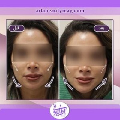 نمونه کار لیفت صورت با نخ در آرتابیوتی
