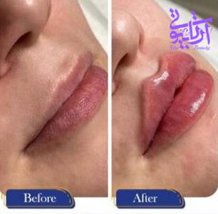 نمونه کار تزریق فیلر لب در آرتا بیوتی