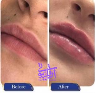 نمونه کار تزریق فیلر لب در آرتا بیوتی