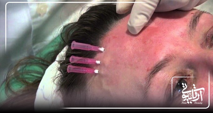 لیفت پیشانی با نخ برای چه افرادی مناسب است؟
