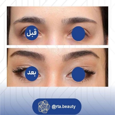 نمونه کار لیفت شقیقه در آرتابیوتی 