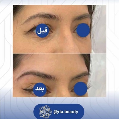نمونه کار لیفت شقیقه در آرتابیوتی 